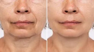 Before and after Facelift