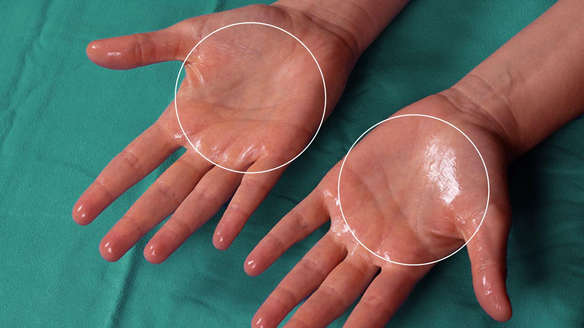 Hyperhidrosis Treatment | Award-winning Aesthetics Clinic Swindon